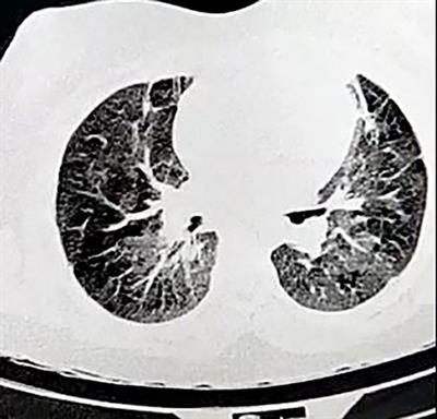 Right Atrial Thrombus in a COVID-19 Child Treated Through Cardiac Surgery